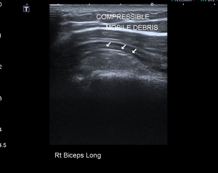 File:Calcific tendinitis (ruptured) (Radiopaedia 56393-63053 A 7).png