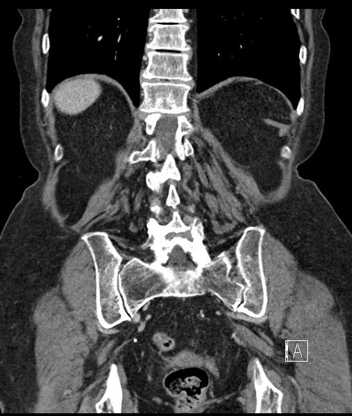 File:Calcified adrenal glands and Spigelian hernia (Radiopaedia 49741-54988 B 89).jpg