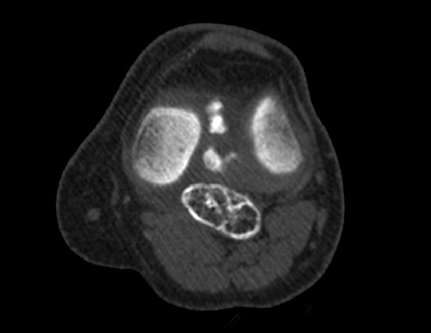 Calcified hematoma - popliteal fossa (Radiopaedia 63938-72763 Axial bone window 20).jpg