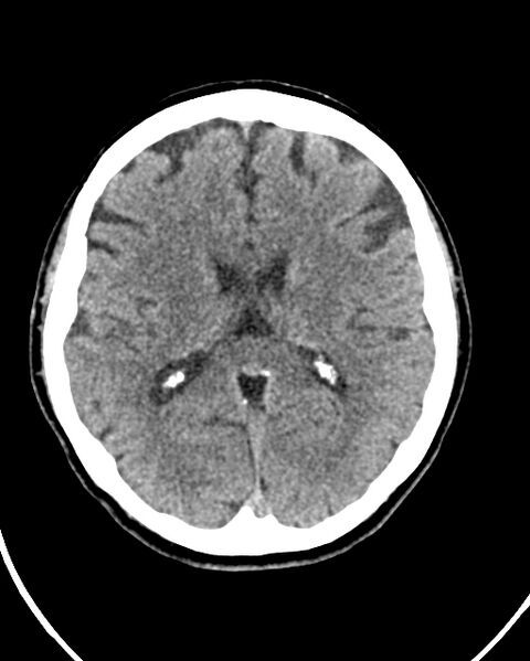 File:Calcified meningioma (Radiopaedia 74361-85243 Axial non-contrast 23).jpg