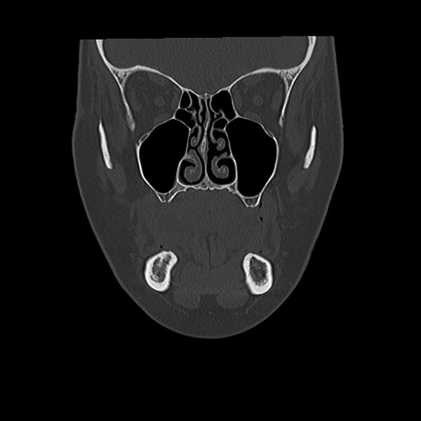 File:Canal up mastoidectomy (Radiopaedia 78108-90638 Coronal bone window 8).jpg