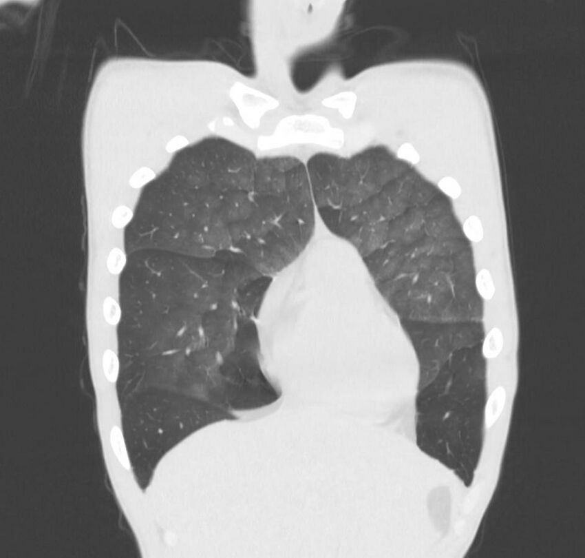 Cannabis-induced diffuse alveolar hemorrhage (Radiopaedia 89834-106946 Coronal lung window 71).jpg
