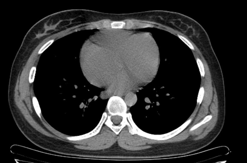 Cannonball metastases - uterine choriocarcinoma (Radiopaedia 70137-80173 Axial non-contrast 76).jpg