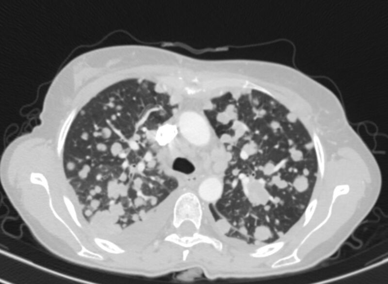 File:Cannonball metastases from breast cancer (Radiopaedia 91024-108569 Axial lung window 29).jpg