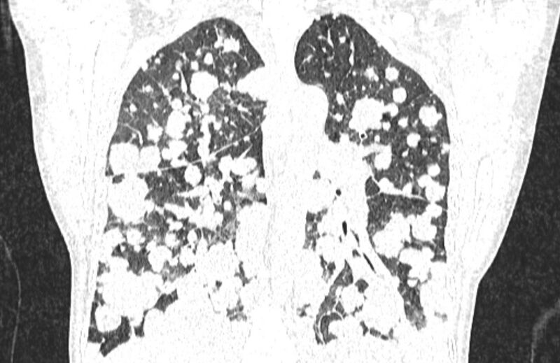 File:Cannonball metastases from breast cancer (Radiopaedia 91024-108569 Coronal lung window 94).jpg