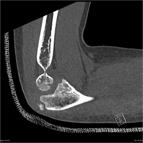 File:Capitellum fracture (Radiopaedia 23352-23426 Sagittal bone window 33).jpg