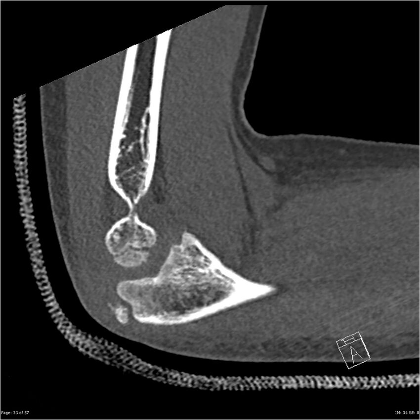 Capitellum fracture (Radiopaedia 23352-23426 Sagittal bone window 33).jpg