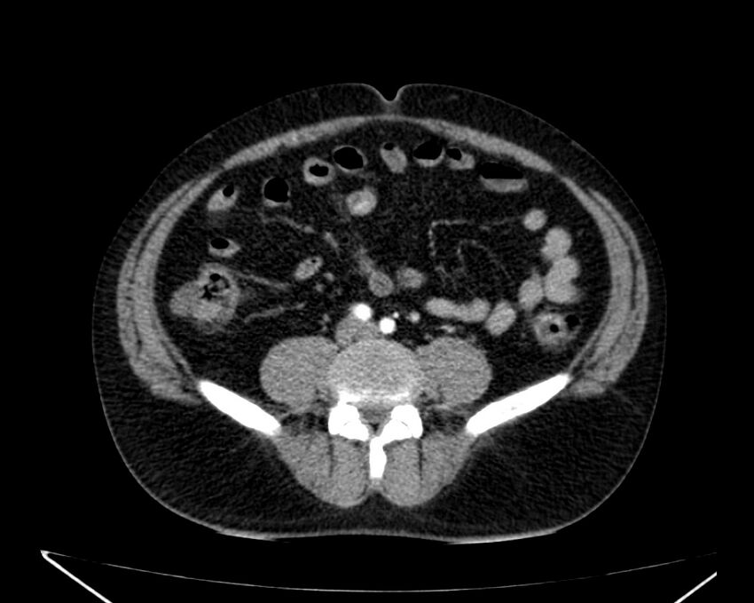 Carcinoid tumor with hepatic metastases (Radiopaedia 22651-22670 B 56).jpg