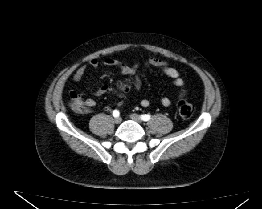 Carcinoid tumor with hepatic metastases (Radiopaedia 22651-22670 B 61).jpg