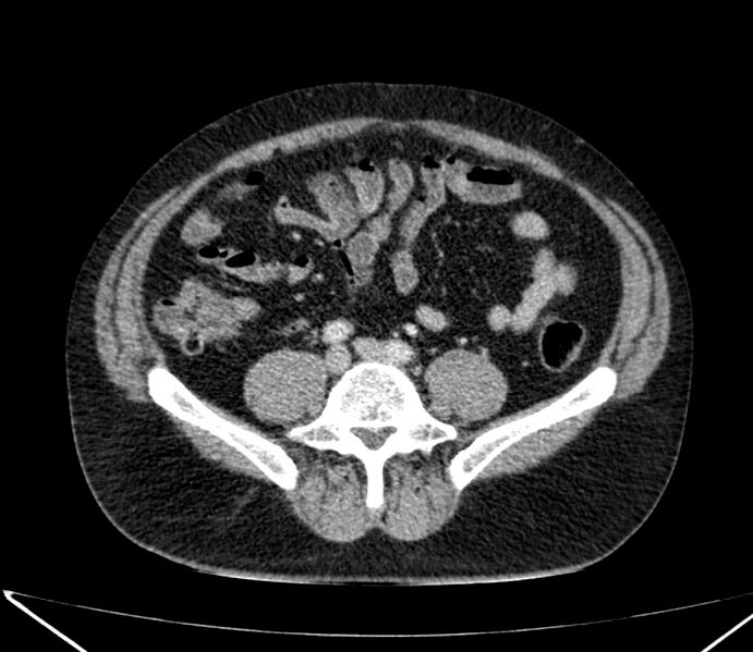 File:Carcinoid tumor with hepatic metastases (Radiopaedia 22651-22670 C 58).jpg