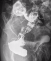 Carcinoma of rectum (Radiopaedia 27843-28085 Oblique 1).PNG