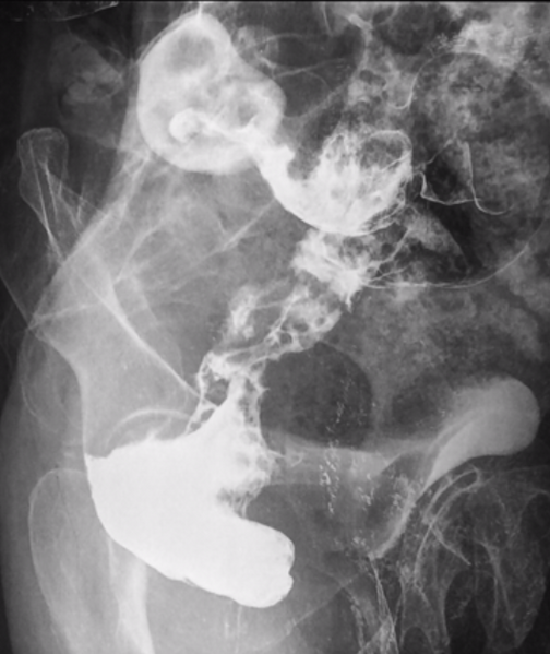 File:Carcinoma of rectum (Radiopaedia 27843-28085 Oblique 1).PNG