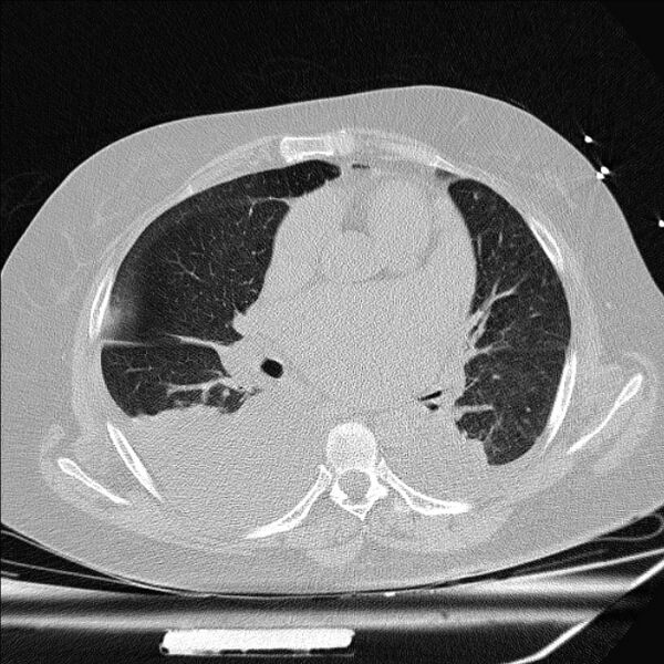 File:Cardiogenic pulmonary edema (Radiopaedia 29213-29609 Axial lung window 49).jpg