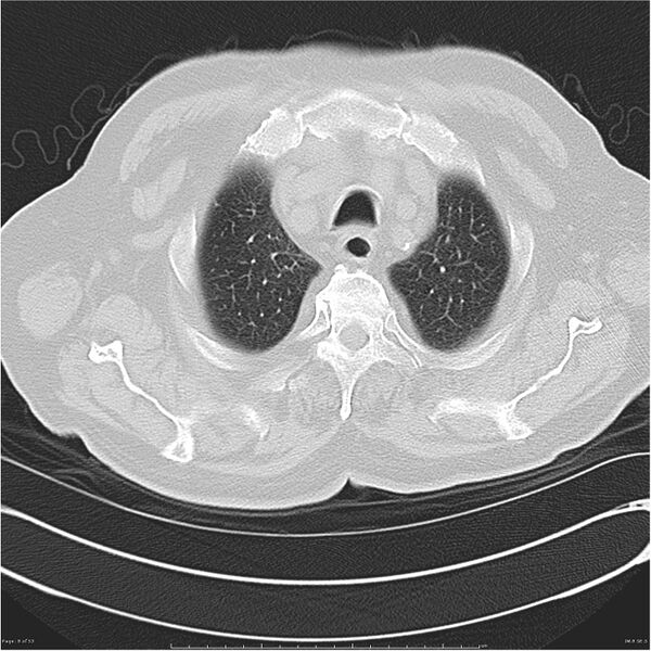 File:Cavitating left lower lobe lesion - squamous cell lung cancer (Radiopaedia 27749-28176 Axial lung window 8).jpg