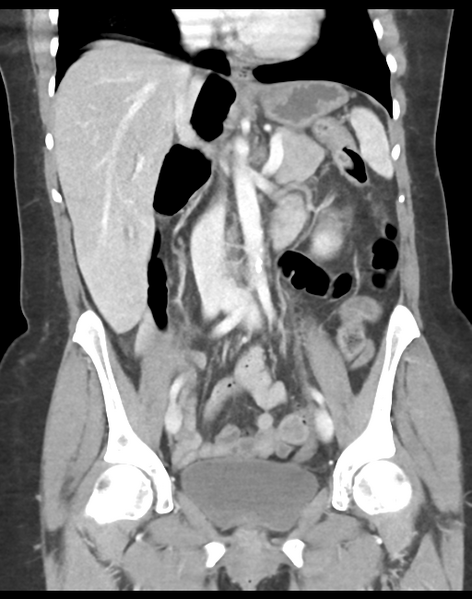 File:Cecum hernia through the foramen of Winslow (Radiopaedia 46634-51112 B 24).png