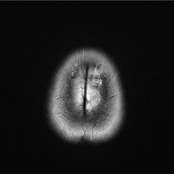 File:Central base of skull meningioma (Radiopaedia 53531-59549 Axial T2 20).jpg