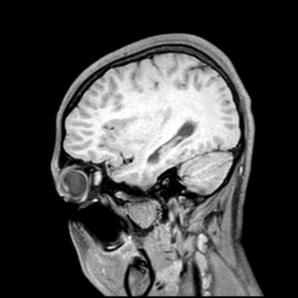 File:Central neurocytoma (Radiopaedia 79320-92380 Sagittal T1 74).jpg