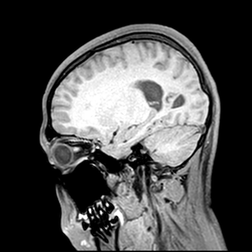 Central neurocytoma (Radiopaedia 79320-92380 Sagittal T1 89).jpg