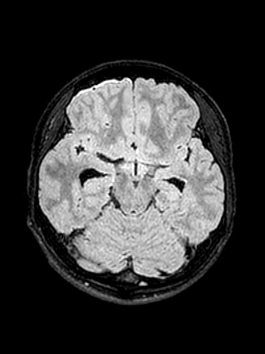 Central neurocytoma (Radiopaedia 79320-92381 Axial FLAIR 106).jpg