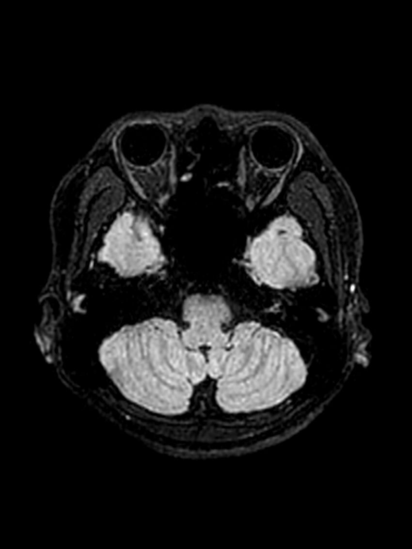 Central neurocytoma (Radiopaedia 79320-92381 Axial FLAIR 127).jpg