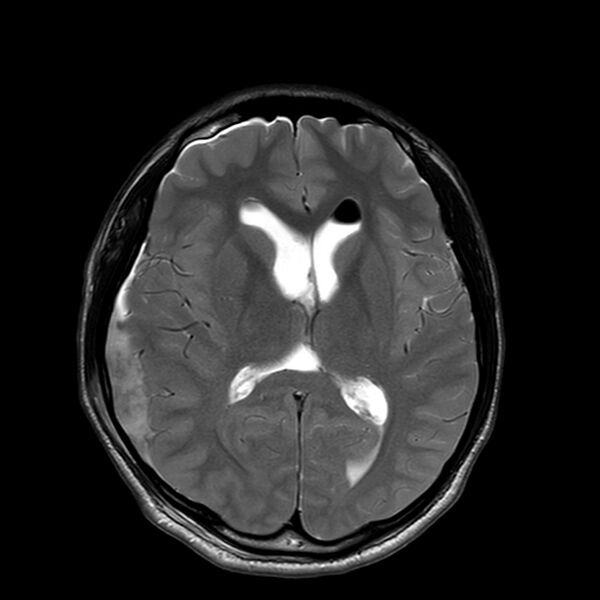File:Central neurocytoma (Radiopaedia 79320-92381 Axial T2 14).jpg