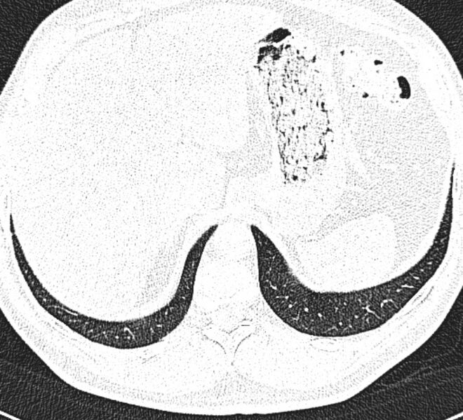 File:Centrilobular pulmonary emphysema (Radiopaedia 26808-26971 Axial lung window 36).jpg