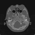 Cerebellar abscess secondary to mastoiditis (Radiopaedia 26284-26413 Axial bone window 33).jpg