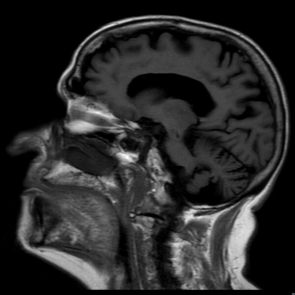 File:Cerebellar ataxia with neuropathy and vestibular areflexia syndrome (CANVAS) (Radiopaedia 74283-85159 Sagittal FLAIR 9).jpg