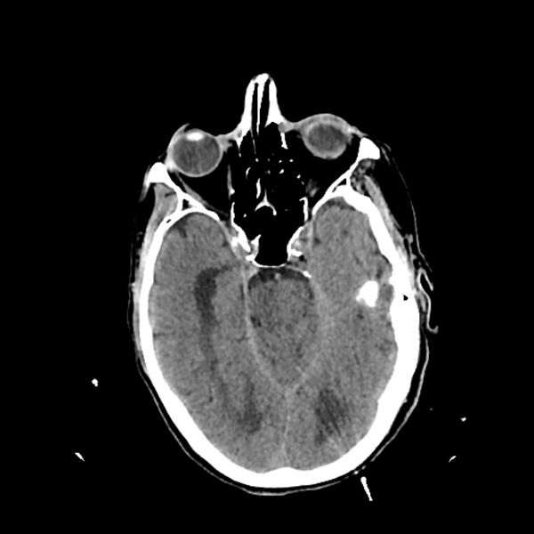 File:Cerebellar metastasis - lung tumor (Radiopaedia 69317-79145 Axial non-contrast 12).jpg