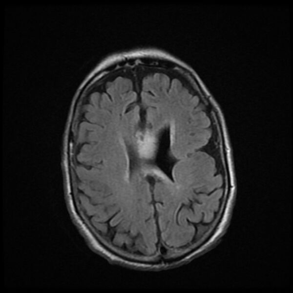File:Cerebellar metastasis - lung tumor (Radiopaedia 69317-79147 Axial FLAIR 6).jpg