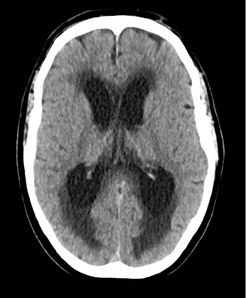 File:Cerebellar metastasis from lung adenocarcinoma (Radiopaedia 86690-102828 Axial non-contrast 16).png