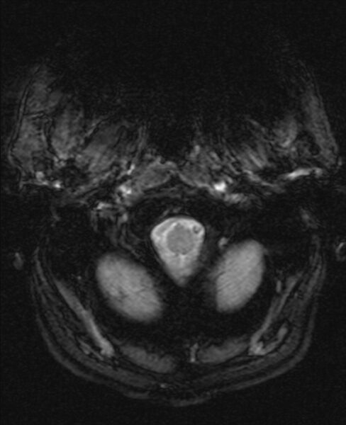 File:Cerebellopontine angle meningioma (Radiopaedia 24459-24764 Axial Gradient Echo 1).jpg