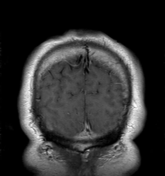 File:Cerebellopontine angle meningioma (Radiopaedia 24459-24764 Coronal T1 C+ 23).jpg