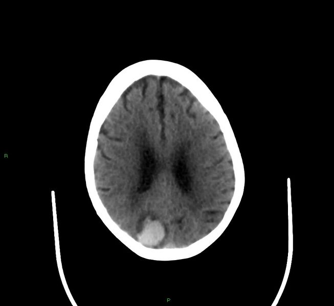 File:Cerebral amyloid angiopathy-associated lobar intracerebral hemorrhage (Radiopaedia 58377-65514 Axial non-contrast 17).jpg