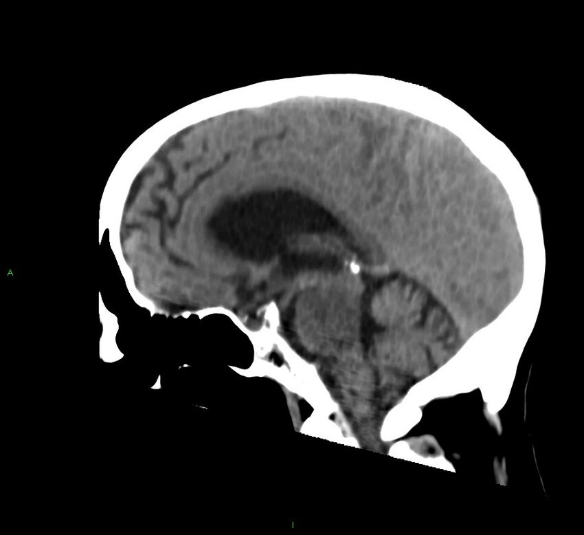 Cerebral amyloid angiopathy-associated lobar intracerebral hemorrhage (Radiopaedia 58530-65688 C 29).jpg
