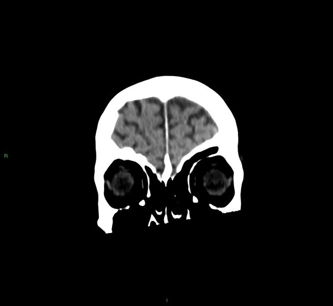 File:Cerebral amyloid angiopathy-associated lobar intracerebral hemorrhage (Radiopaedia 58530-65688 Coronal non-contrast 57).jpg