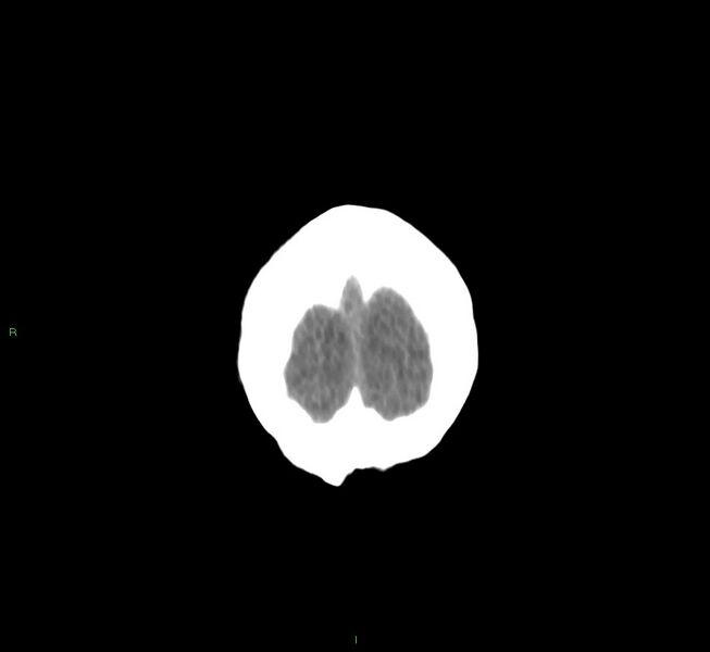 File:Cerebral amyloid angiopathy-associated lobar intracerebral hemorrhage (Radiopaedia 58530-65688 Coronal non-contrast 7).jpg