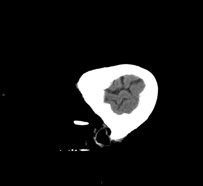 File:Cerebral amyloid angiopathy-associated lobar intracerebral hemorrhage (Radiopaedia 58560-65723 C 47).jpg