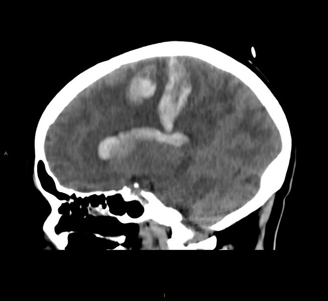 File:Cerebral amyloid angiopathy-associated lobar intracerebral hemorrhage (Radiopaedia 58566-65730 C 22).jpg