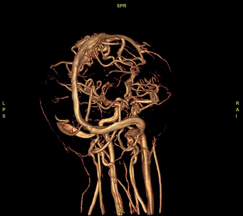 Cerebral arteriovenous malformation (Radiopaedia 61964-70029 VRT 20).jpg