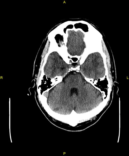 File:Cerebral autosomal dominant arteriopathy with subcortical infarcts and leukoencephalopathy (CADASIL) (Radiopaedia 86108-102051 Axial non-contrast 30).jpg