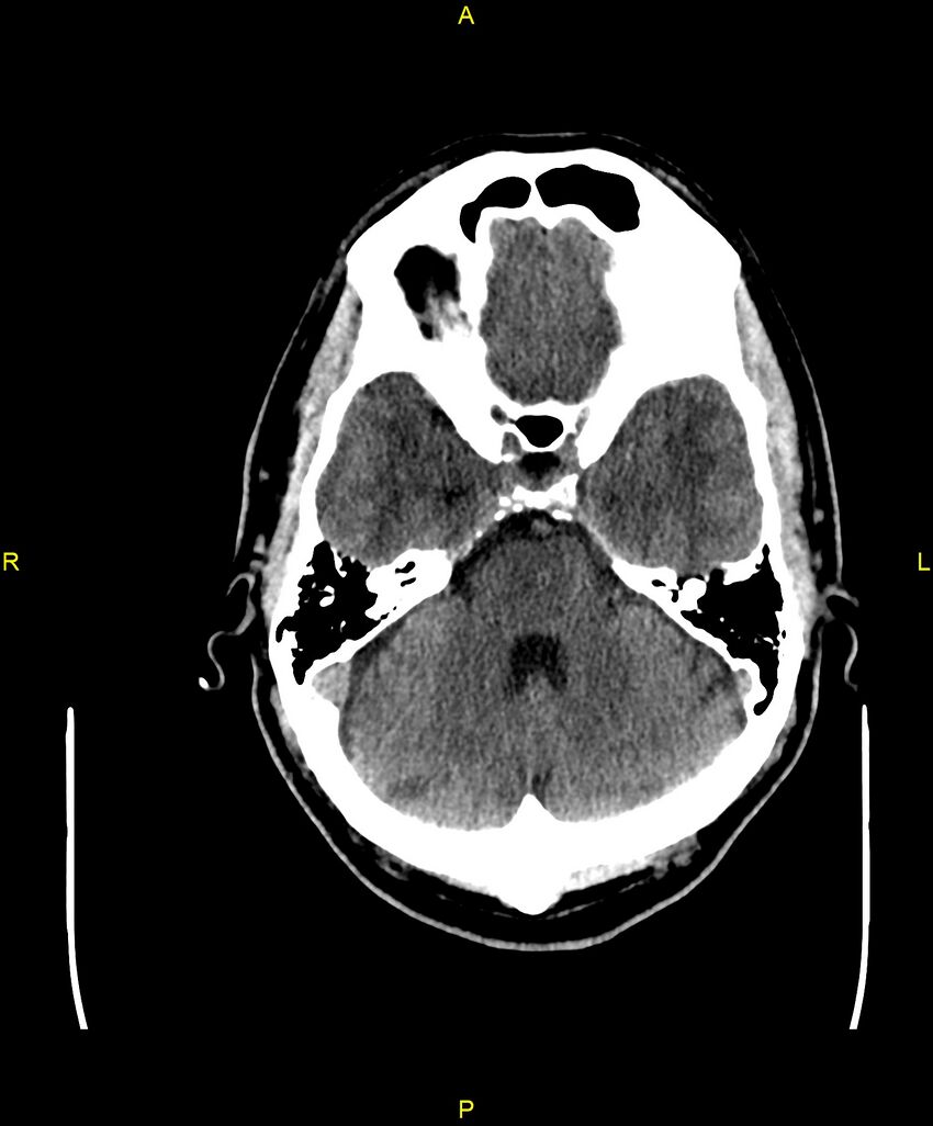 Cerebral autosomal dominant arteriopathy with subcortical infarcts and leukoencephalopathy (CADASIL) (Radiopaedia 86108-102051 Axial non-contrast 30).jpg