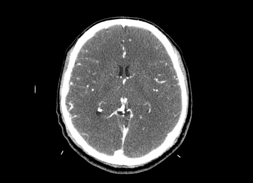 Cerebral edema (Radiopaedia 82519-96661 B 29).jpg
