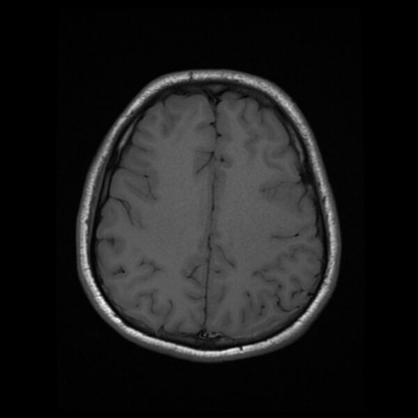 File:Cerebral fat embolism (Radiopaedia 37510-39363 Axial T1 19).jpg