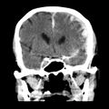 Cerebral hemorrhagic contusions (Radiopaedia 23145-23188 Coronal non-contrast 17).jpg