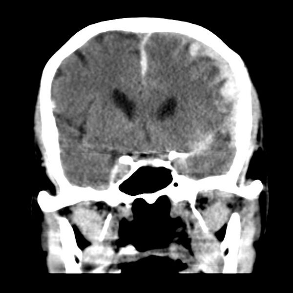 File:Cerebral hemorrhagic contusions (Radiopaedia 23145-23188 Coronal non-contrast 17).jpg