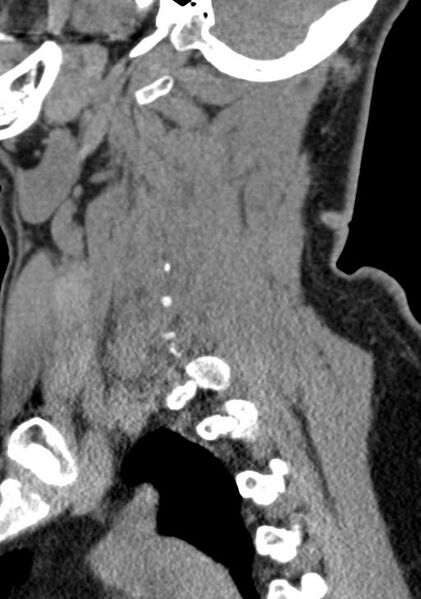 File:Cerebral hemorrhagic contusions and cervical spine fractures (Radiopaedia 32865-33841 G 35).jpg