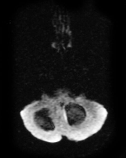 File:Cerebral metastases - small cell lung cancer (Radiopaedia 3972-6521 Axial DWI 1).jpg