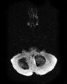 Cerebral metastases - small cell lung cancer (Radiopaedia 3972-6521 Axial DWI 1).jpg