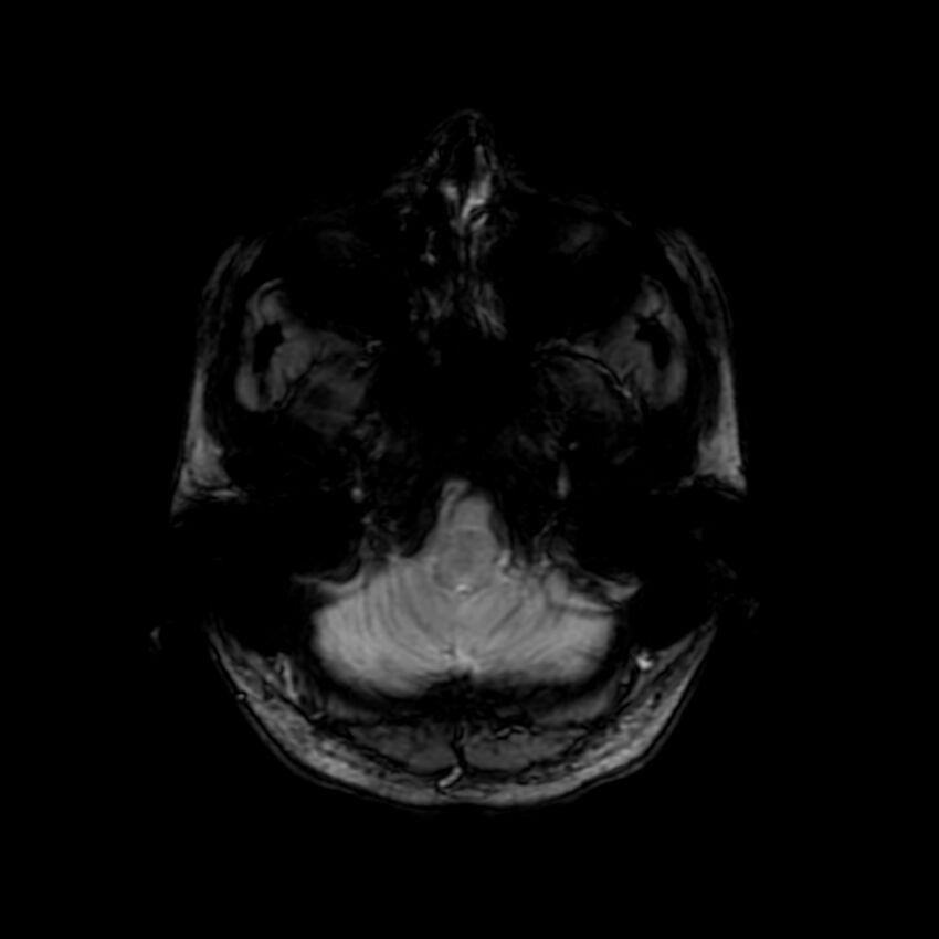 Cerebral paragonimiasis (Radiopaedia 73473-84238 Axial SWI 11).jpg